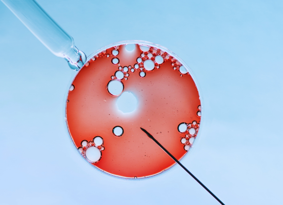 IVF treatment - In vitro fertilization